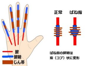 ばね指001