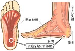 足底筋膜炎　画像