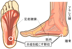 足底腱膜炎1