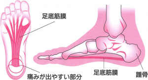 足底筋膜炎