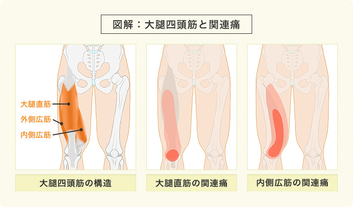 膝痛の図解