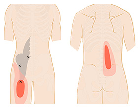 筋 膿瘍 腰 腸