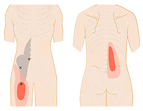 腸腰筋が原因の腰痛 京都平川接骨院 鍼灸治療院グループ