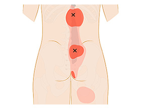 多裂筋の関連痛