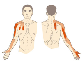 斜角筋が原因の痛みやしびれ 京都平川接骨院 鍼灸治療院グループ